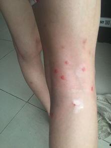 吃瓜过敏起红点 第2张 吃瓜过敏起红点 第2张